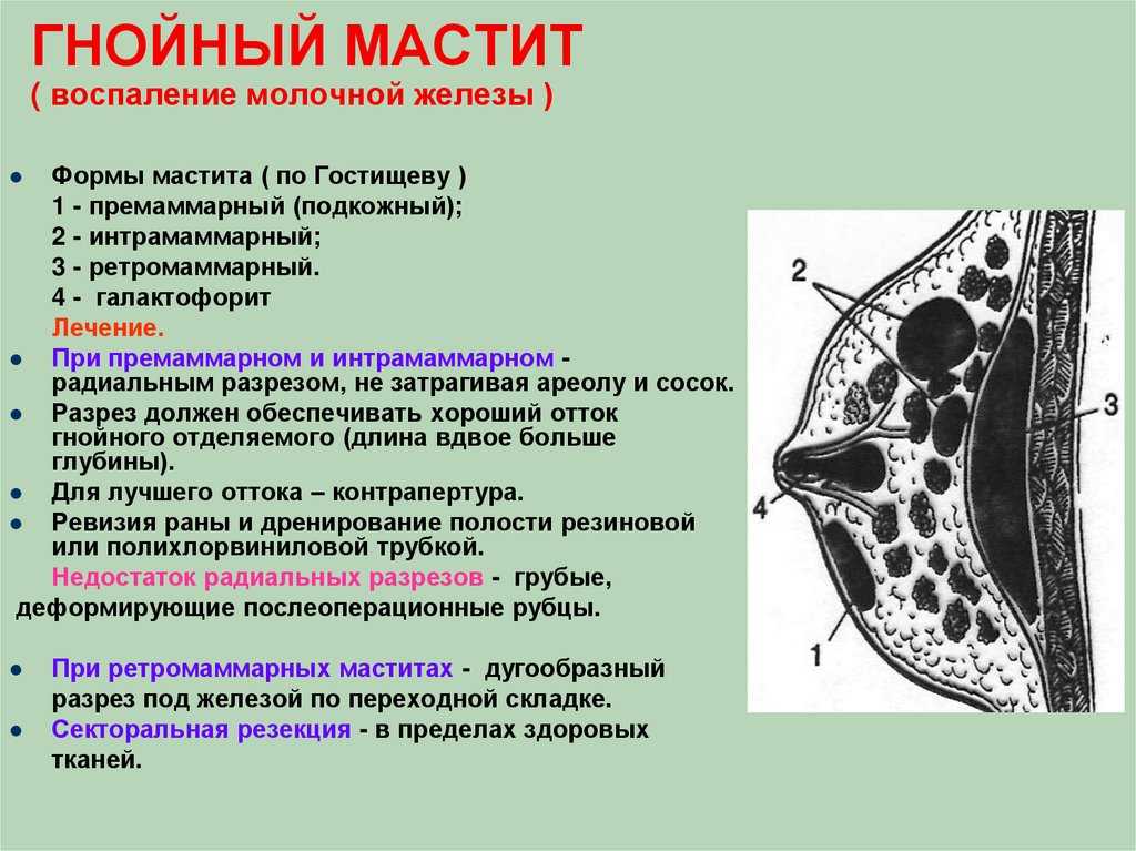 Мастит при гв фото