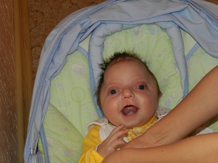 Синюшность носогубного треугольника у новорожденных фото